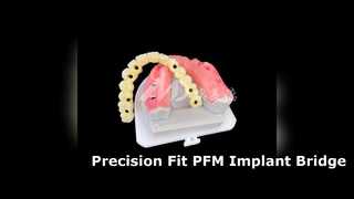 高強度 PFM インプラント ブリッジの正確なフィット感