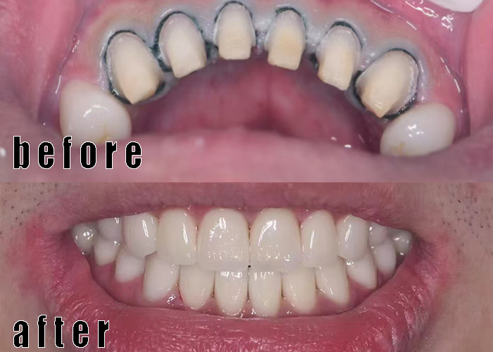 企業に関する最新事例 ジルコニアの王冠