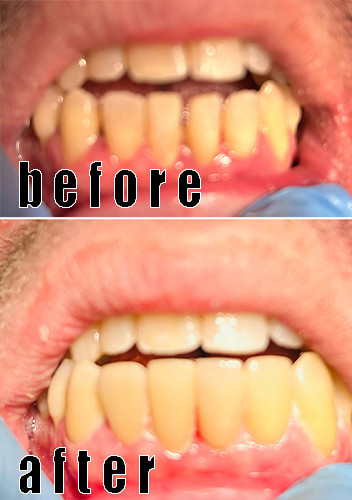 企業に関する最新事例 Emaxファニヤーは開いた噛みをつぶすために使用されました