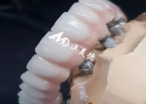購入 独占的な高性能歯科インプラント クラウンブリッジ 様々なサイズ online manufacture