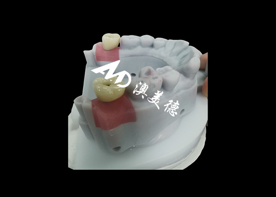 購入 耐久性のある歯修復のためのチタン支柱付き歯科インプラント王冠 online manufacture