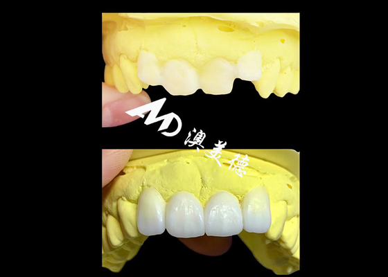 購入 AMD歯科研究室によって製造されたカスタム透明ジルコニア歯科冠 online manufacture