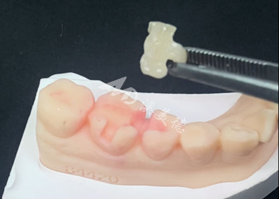 購入 Emaxセラミックインレー・アンレー 歯の修復 天然歯の色 online manufacture