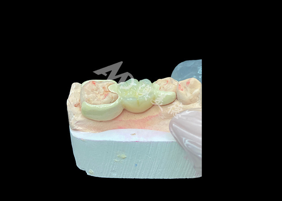 購入 微笑みの美容と生物互換性を向上させるため,HPP結合橋付きジルコニアクラウン online manufacture
