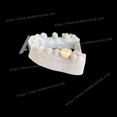 購入 PFM Maryland Bridge One Pontic Two Wings A Conservative and Esthetic Solution online manufacture