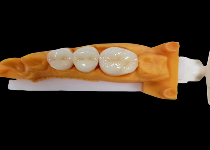 耐磨性 Zirconia 歯冠 中国製歯科ラボから