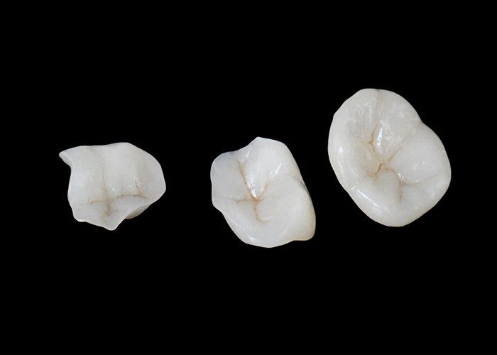 快適な耐久性と自然歯とのシームレスな統合のために設計された生物互換性セラミックインレイとオンレイ