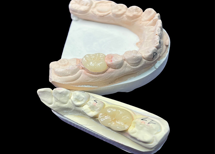 IPS e.max 粘膜修復のための陶器インレイとオンレイ 長期効果のための自然な美学と優れた耐久性