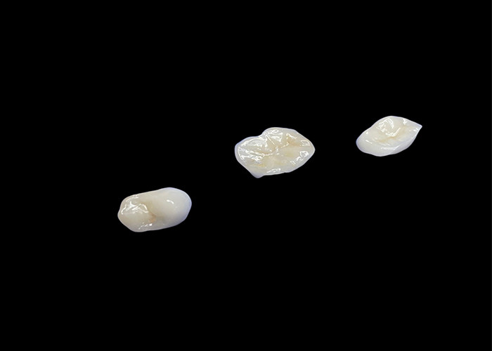 快適な耐久性と自然歯とのシームレスな統合のために設計された生物互換性セラミックインレイとオンレイ