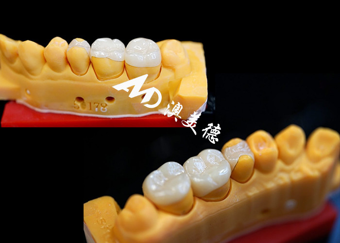 OEM 精密フィット セラミックインレイ 耐久性があり,自然に見える歯修復のためのインレイ 優れた強度と信頼性