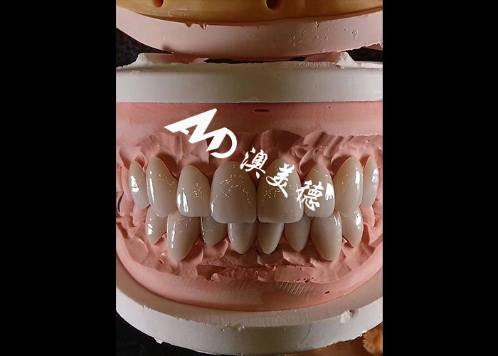 整形歯科 エマックス 歯科フェニール 厚さ0.3-0.5mm 美容修復用