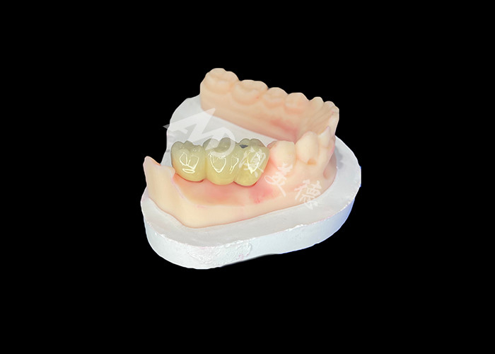 PFM 歯科 冠 歯科 冠 歯科 冠 歯科 冠 歯科 冠 歯科 冠 歯科 冠 歯科 冠 歯科 冠 歯科 冠 歯科 冠 歯科 冠 歯科 冠 歯科 冠 歯科 冠 歯科 冠 歯科 冠 歯科 冠 歯科 冠 歯科 冠 歯科 冠