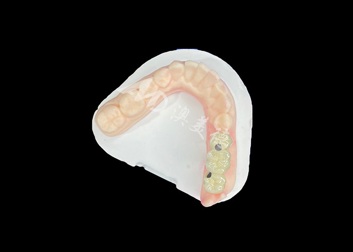 PFM 歯科 冠 歯科 冠 歯科 冠 歯科 冠 歯科 冠 歯科 冠 歯科 冠 歯科 冠 歯科 冠 歯科 冠 歯科 冠 歯科 冠 歯科 冠 歯科 冠 歯科 冠 歯科 冠 歯科 冠 歯科 冠 歯科 冠 歯科 冠 歯科 冠