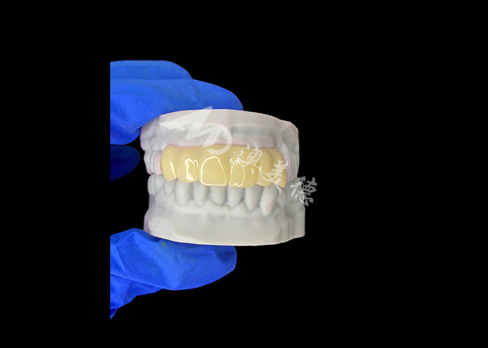 軽量 バイオコンパティブル 3Dプリント 埋め込み前修復用の空洞一時橋