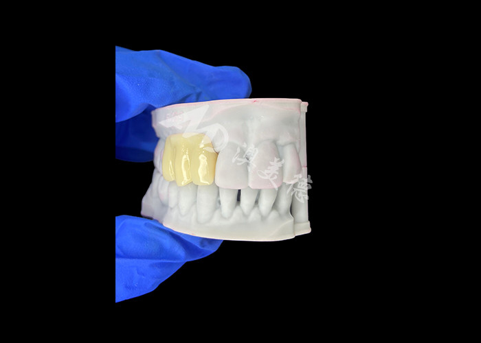 軽量 バイオコンパティブル 3Dプリント 埋め込み前修復用の空洞一時橋